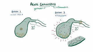 Acute cholecystitis   causes, symptoms, diagnosis, treatment & pathology