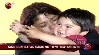 Madre desesperada busca tratamiento para su hijo que padece elefantiasis - CHV Noticias