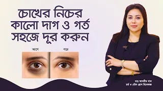 চোখের নিচে কালো দাগ ও গর্ত দূর করার উপায়। Ways to remove dark spots and holes under the eyes.