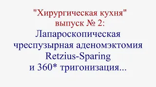 Аденомэктомия/simple prostatectomy for BPH/Retzius Sparing/лапароскопическая аденомэктомия/Кочкин