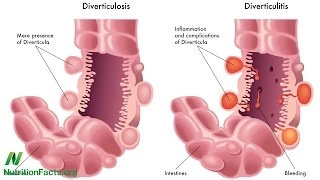 Diverticulosis: When Our Most Common Gut Disorder Hardly Existed