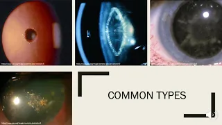 Vision Loss and Cataract