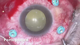 Endophthalmitis Vitrectomy