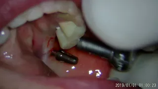 Cómo hacer una cirugía de implante con microscopio