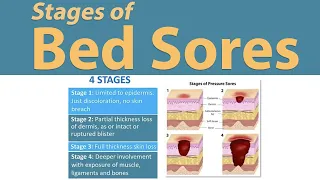 Stages of Bed sores | Pressure Sores