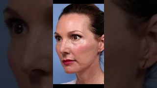 Facial Rejuvenation Transformation | Bay Area's Best Facial Plastic Surgeons