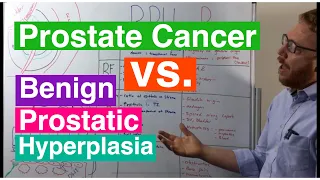 Benign Prostatic Hyperplasia vs Prostate Cancer