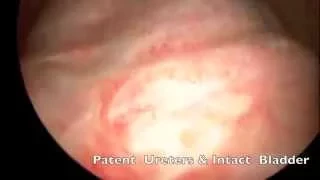 Gynecologist San Francisco | Da Vinci Robotic Surgery | Prevent Preterm Labor/Miscarriage