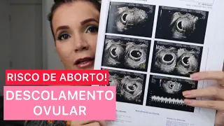 TIVE DESCOLAMENTO OVULAR COM 6 SEMANAS DE GESTAÇÃO: COMO FOI? COMO ME RECUPEREI? #DIARIODEGRAVIDEZ