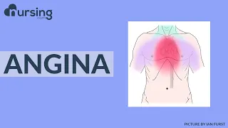 Angina can be pretty scary for your patient, let's talk about how to best help them with it.