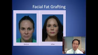 How Do I Add Volume to My Cheeks - Facial Fat Grafting Consultation - Dr. Anthony Youn