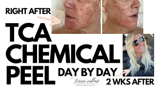 CHEMICAL PEEL | Procedure | Peeling | Before & After ONE FULL WEEK TCA  PEEL AND 2 WEEKS AFTER