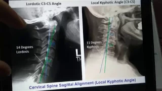 Cervical myelopathy Part 1