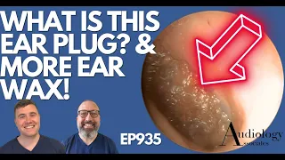 WHAT IS THIS EAR PLUG? & MORE EAR WAX REMOVALS - EP935