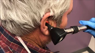 Giant Ear Wax Removal, Painful Blockage! Dr Gilmore