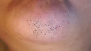 Hair removal asmr pull out with Tweezers  Satisfying pull out beard 12min 202403-2