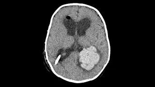 Carcinoma do plexo coróide