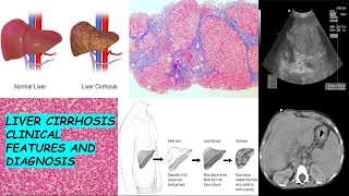 Liver cirrhosis detailed | clinical features and diagnosis |