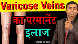 Varicose Veins का पर्मनंट इलाज  cause symptoms treatment Homeopathic treatment