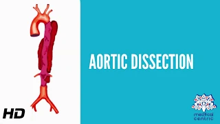 Aortic dissection (AD), Causes, Signs and Symptoms, Diagnosis and Treatment.