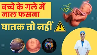 बच्चे के गले में नाल फस जाना? | What Are the Side Effects of Cord Around Neck? | Dr Neeraj Pahlajani