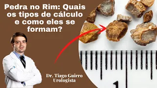 Pedra no Rim: Quais os tipos de cálculo e como eles se formam?