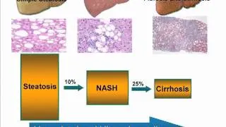 Liver Update - Ep. 3 - Fatty Liver Disease, Alcoholic Liver Disease, and Cholestatis