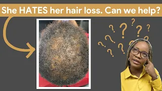 She HATED her scalp condition. Until... [CCCA Transformation Story] #cccaalopecia