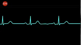 PEA - Pulseless electrical activity