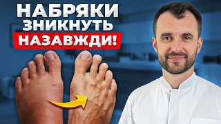 Як ШВИДКО позбавитися від набряків? Справжні причини застою лімфи!