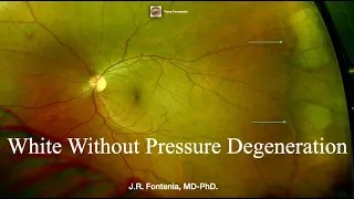 White Without Pressure Degeneration. Peripheral Retinal Degenerations.