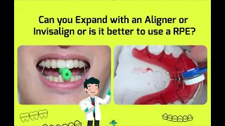 Arch Expansion vs Palatal Expansion