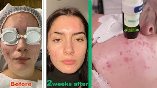 Clear skin laser treatment for ACNE - 2022 bespoke acne innovation treatment that actually works