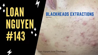 Acne treatment for two male customers (143)  | Loan Nguyen