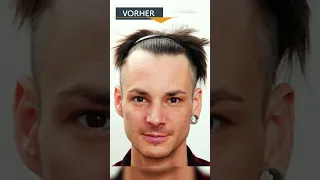 Manuel Fettner - Kontrolle der Haartransplantation nach einem Jahr | Moser Medical