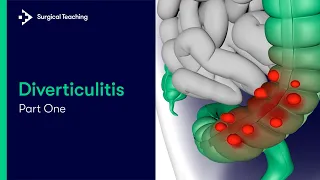 Diverticulitis Part 1 | What is it and What Causes it?