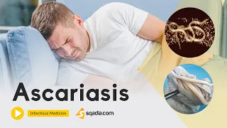 Ascariasis | Infectious Medicine Video | Medical Online Education | V-Learning™
