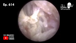 614 - Severe Outer Ear Infection Microsuction