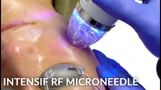 Intensif RF Micro Needling for Acne Scar Treatment | Micro Needling Before and After | Dr Jason Emer