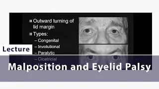 Malposition and Eyelid Palsy