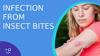 Skin Infection From Bug Bites - Daily Do's of Dermatology