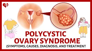 What is Polycystic Ovary Syndrome (PCOS) ? | PCOS Made Easy