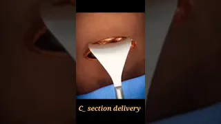 caesarean section # c-section delivery # how c _ section delivery performed # animation of c section