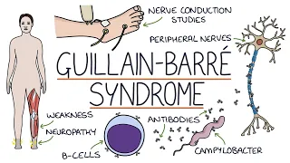 Understanding Guillain-Barré Syndrome