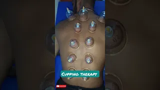 Extreme!! cupping therapy after gym workout #shorts #cupping #gymlover #health #health2022 #swoc