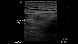 Thigh Ultrasound: Cellulitis of the Thigh (Long Axis, Part 1)