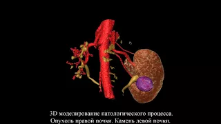 Лапароскопическое удаление опухоли почки