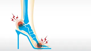 Easy Fixes For High Heel Pain, Arch Pain + Athlete's Foot | Dr. Brad From My Feet Are Killing Me