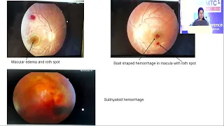 AIOCMTC2 2023 APOS PG Retina FP Session 2 FP771 Dr K INDULATHA A CASE SERIES OF FUNDOSCOPIC FINDINGS