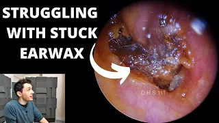 Struggling With Impacted Ear Wax Removal